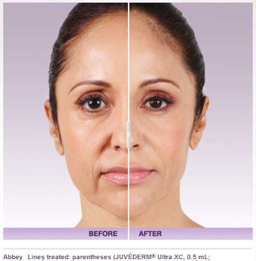 Little Known Questions About Juvederm New Hampshire Portsmouth, Nh - Juvéderm ™ Xc. thumbnail